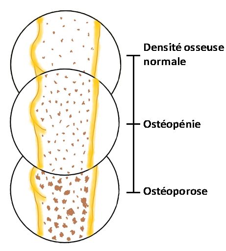 La différence entre la densité osseuse normale, l'ostéopénie et l'ostéoporose