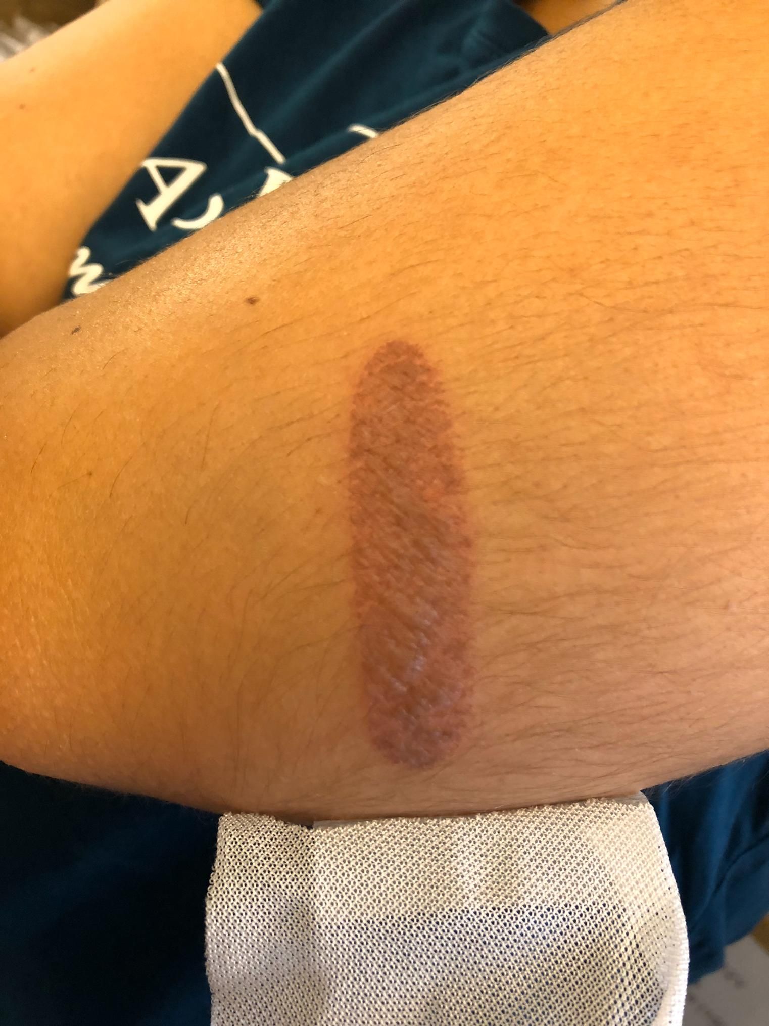 Verbrennung mit DermaSilk behandelt_vorher