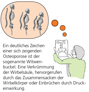 Ein deutliches Zeichen einer sich zeigenden Osteoporose ist der sogenannte Witwenbuckel.