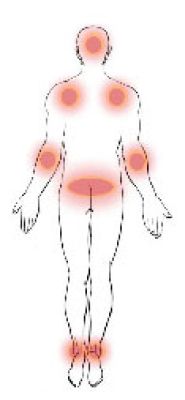 Mögliche Stellen mit Druckwunden/Dekubitus