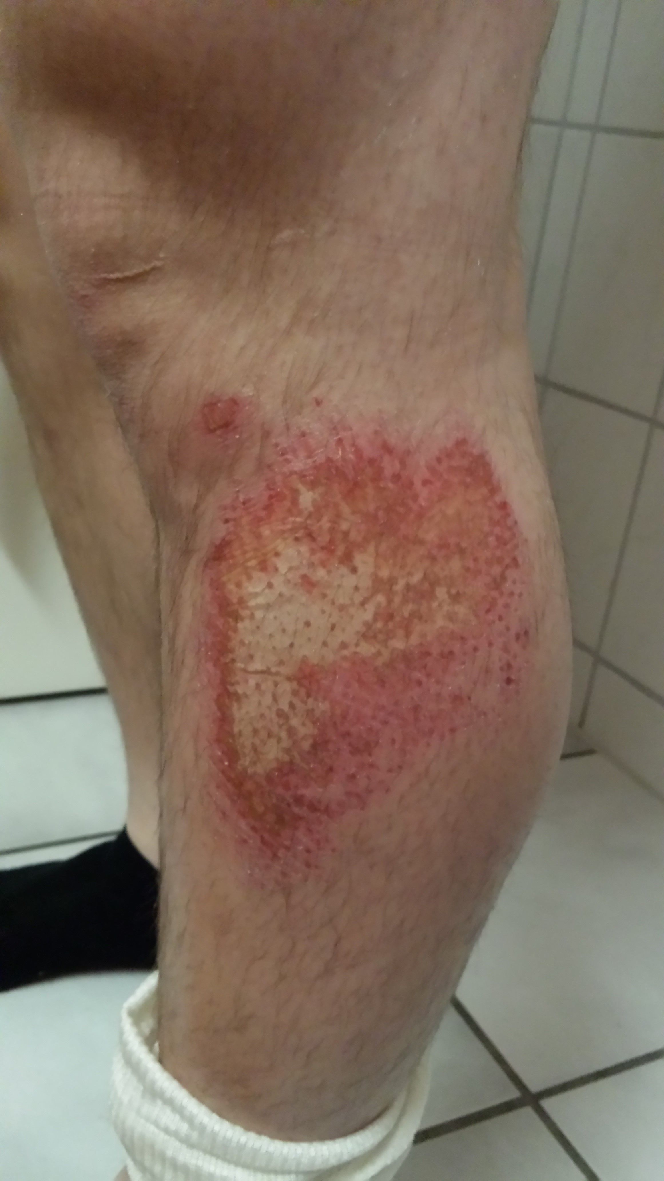 Schürfwunden mit DermaSilk behandeln