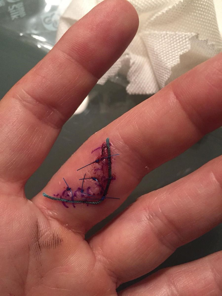 Narbe nach Fingeroperation